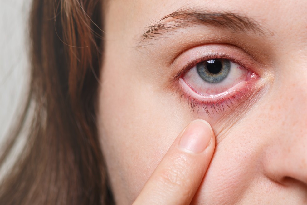 Conjuntivite é uma doença inflamatória nos olhos que pode ter origem bacteriana, alérgica ou viral — Foto: Freepik